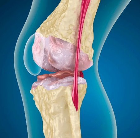 Arthrosose des Kniegelenks