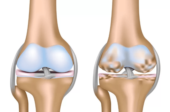 Verformung der Arthrose des Kniegelenks