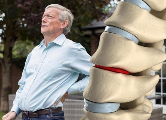 Osteochondrose betrifft die Bandscheiben und verursacht Rückenschmerzen