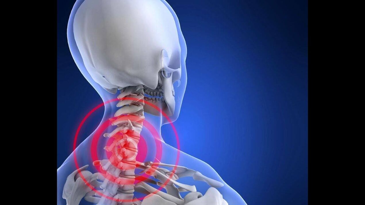 Osteochondrose der Halswirbelsäule