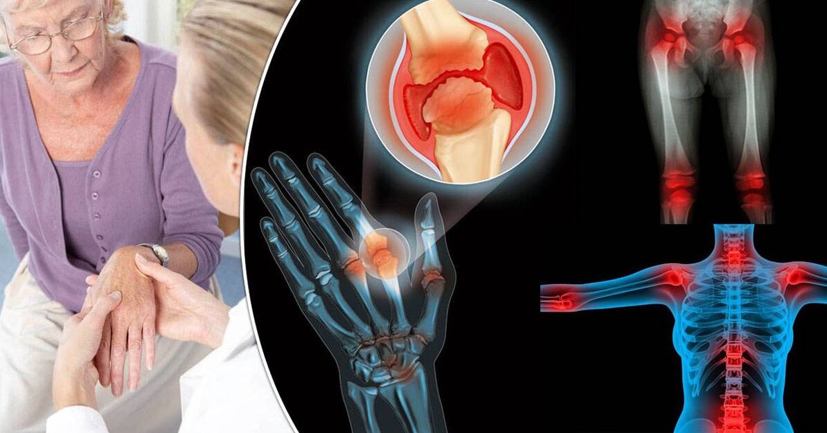 Was ist Arthrose